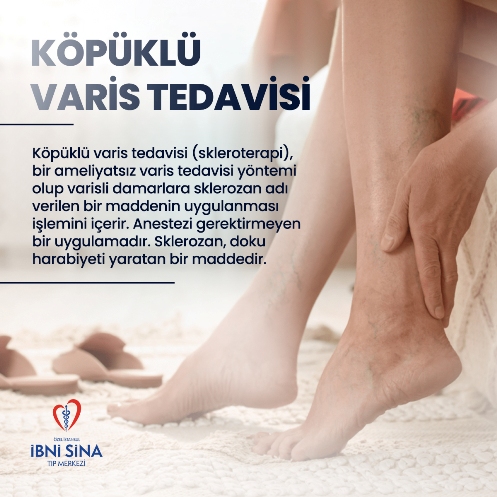 Köpüklü Varis Tedavisi